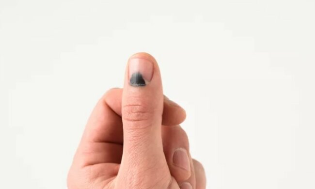 Krwiak pod paznokciem może być oznaką czegoś poważnego. Warto wiedzieć co oznacza