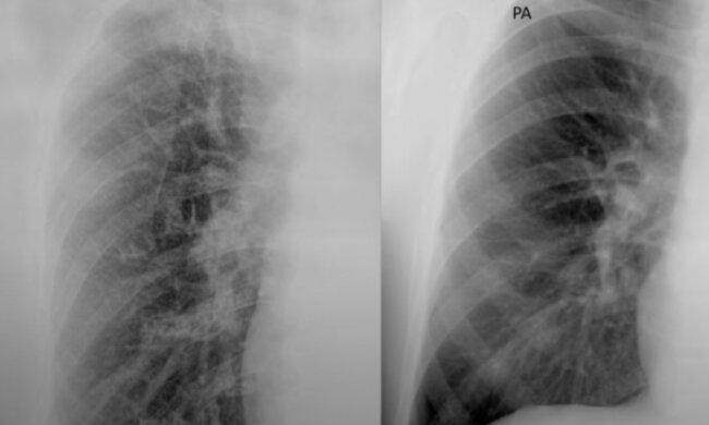 RTG płuc nie pozostawia złudzeń. Koronawirus pozostawia zmiany na narządach