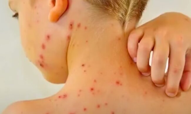 Małpia ospa / YouTube:  Health & Fitness