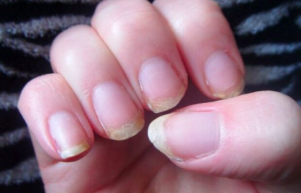 Jak poradzić sobie z łamliwymi paznokciami? / germaindermatology.com