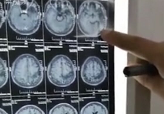 23-latek cierpiał na drętwienie kończyn. Gdy trafił do szpitala po doznaniu paraliżu, lekarze odkryli zaskakujący powód omdlenia