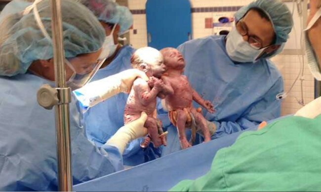 Bliźniaczki urodziły się trzymając się za ręce,screen Google