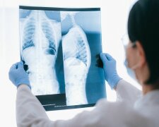 Rak płuca może długo nie dawać oczywistych objawów. Te sygnały łatwo pomylić z infekcją