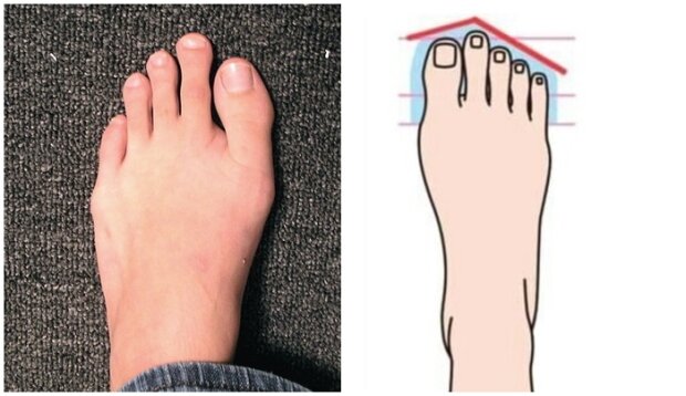 Osoby posiadające dłuższy drugi palec u stopy od największego palucha są obdarzone wyjątkową cechą. O co chodzi
