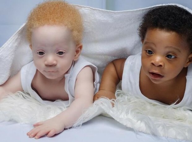 Wyjątkowe bliźnięta. Jedno białe, drugie czarne. Niesamowite zdjęcia. Jak oni żyją?