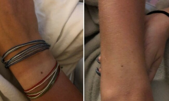 Kobiety na całym świecie znalazły znamiona w tym samym miejscu na ciele. O co chodzi