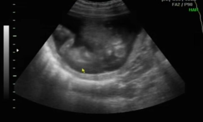 Z życia wzięte. 23-letnia dziewczyna urodziła dzieci rodzone co 480 lat. Niesamowita historia niezwykle trudnego porodu