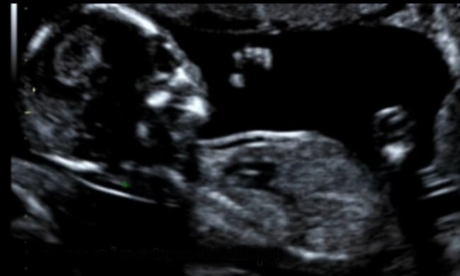 Badanie USG/ YouTube @siostra Ania