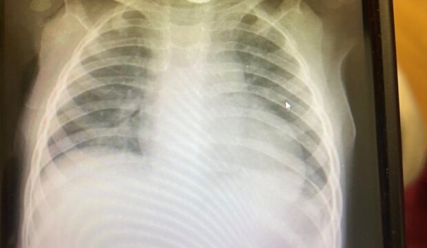 Prześwietlenie płuc. Źródło: Facebook Bristol Royal Hospital for Children