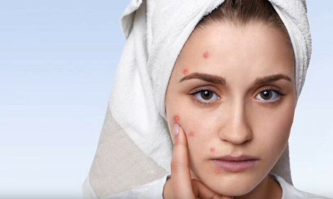 Ospa wietrzna/YT @Swasthaya tips