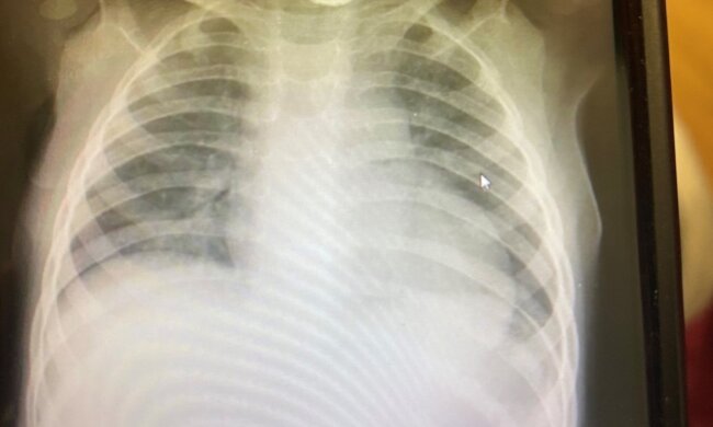 Prześwietlenie płuc. Źródło: Facebook Bristol Royal Hospital for Children