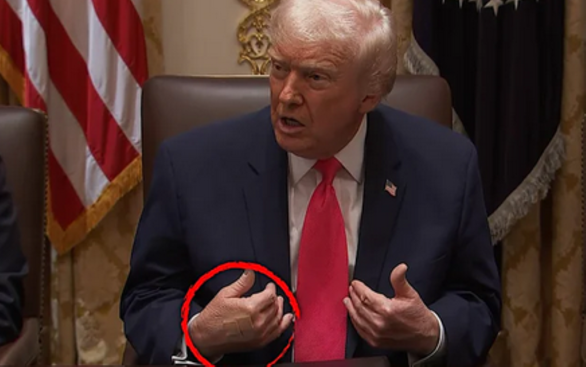 Obawy o stan zdrowia prezydenta Donalda Trumpa. Wszystko przez jego ręce